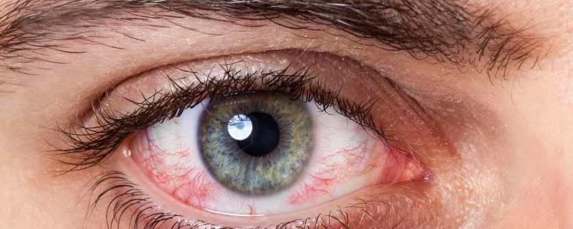 ojos rojos causas
